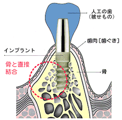 �C���v�����g����