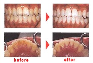 真剣に 反乱 不完全な 電動 歯ブラシ 歯石 除去 Grandir Surf Jp