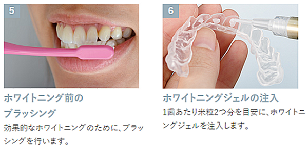 ブラッシングとホワイトニングジェルの注入