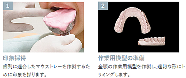 マウスピース製作。印象採得と作業用模型の準備