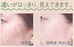 ケミカルピーリング 自宅で簡単ケミカルピーリング ホーム