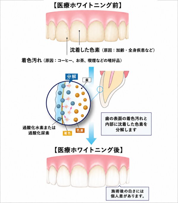 ホワイトバンドは歯医者によるホワイトニングを継続することで目立たなくなります。